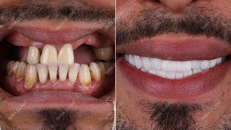 veneers before and after